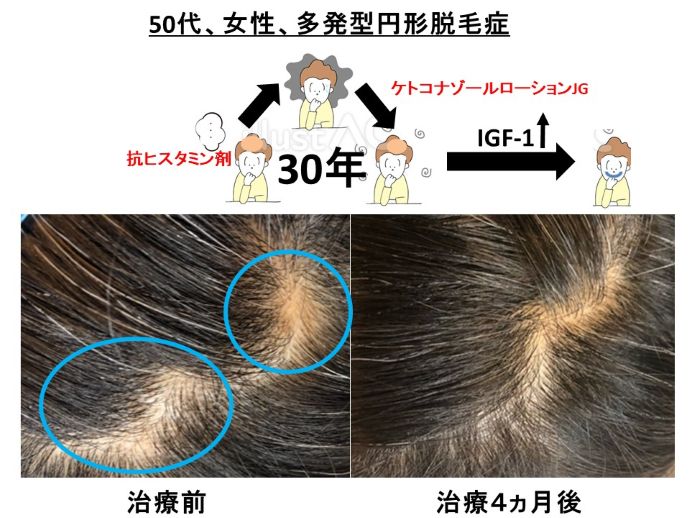 円形脱毛症　病院